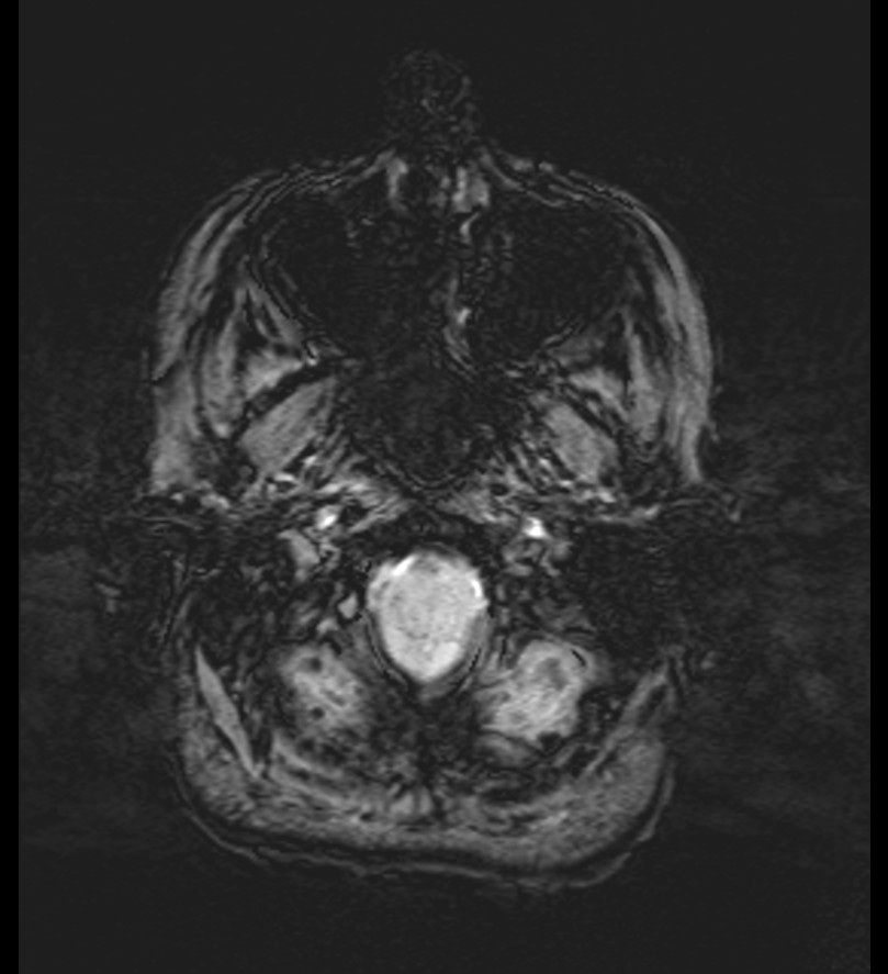 Choroid plexus xanthogranuloma (Radiopaedia 91271-108875 Axial SWI 8).jpg