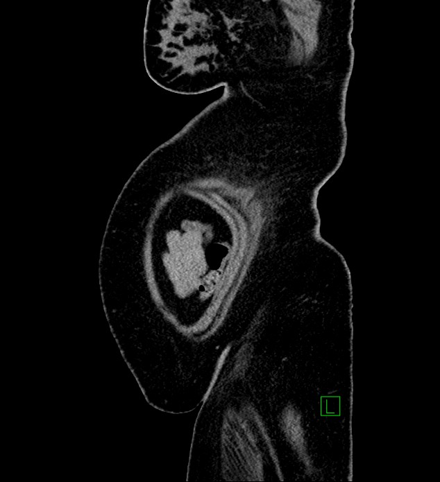 Chromophobe renal cell carcinoma (Radiopaedia 84239-99519 G 8).jpg