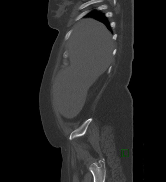 Chromophobe renal cell carcinoma (Radiopaedia 84239-99519 Sagittal bone window 93).jpg