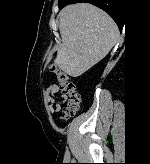 Chromophobe renal cell carcinoma (Radiopaedia 84286-99573 I 157).jpg