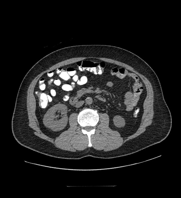 Chromophobe renal cell carcinoma (Radiopaedia 84337-99644 Axial non-contrast 49).jpg