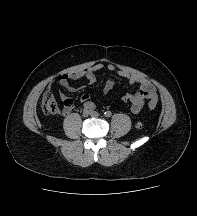 Chromophobe renal cell carcinoma (Radiopaedia 84337-99693 Axial non-contrast 98).jpg