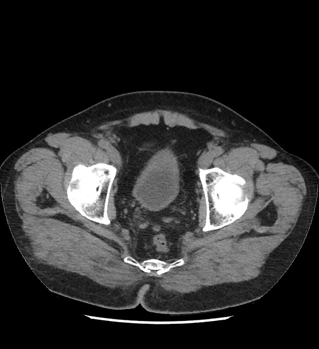 Chromophobe renal cell carcinoma (Radiopaedia 86879-103083 Axial non-contrast 119).jpg