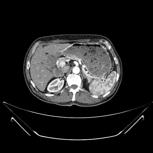 File:Chronic contained rupture of abdominal aortic aneurysm with extensive erosion of the vertebral bodies (Radiopaedia 55450-61901 A 9).jpg