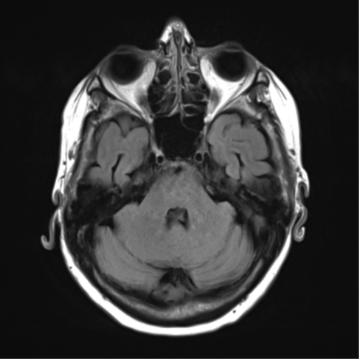 File:Chronic hypertensive encephalopathy (Radiopaedia 39993-42482 Axial FLAIR 7).png