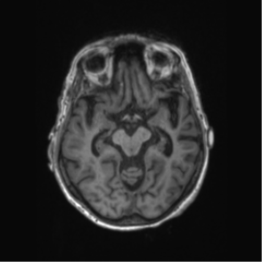 File:Chronic hypertensive encephalopathy (Radiopaedia 72844-83495 Axial T1 44).png