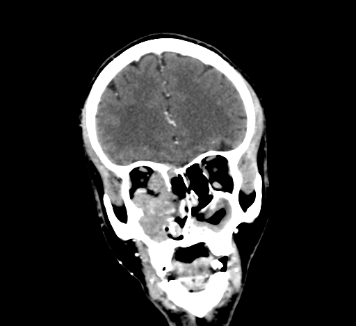 Chronic invasive fungal sinusitis with intraorbital and intracranial extension (Radiopaedia 56387-63046 C 111).jpg
