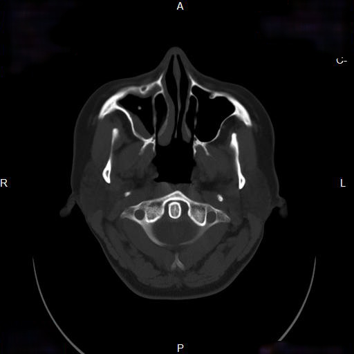 File:Chronic maxillary sinusitis with a foreign body (dental filling material) (Radiopaedia 7811-8639 Axial bone window 5).jpg