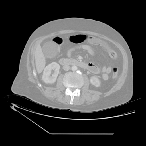 File:Chronic mesenteric ischemia - arterial (Radiopaedia 88205-104810 Axial lung window 11).jpg