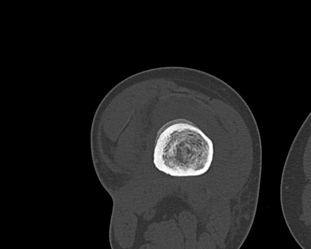 Chronic ostemyelitis of the femur with long sinus tract (Radiopaedia 74947-85982 Axial bone window 155).jpg
