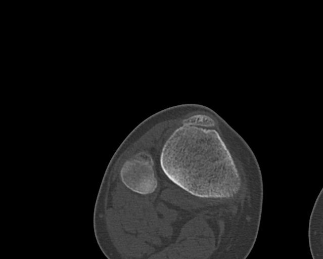 Chronic ostemyelitis of the femur with long sinus tract (Radiopaedia 74947-85982 Axial bone window 246).jpg