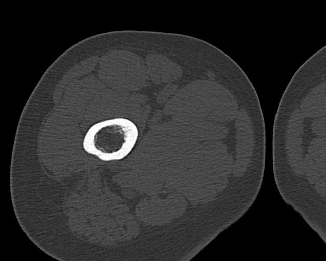 Chronic ostemyelitis of the femur with long sinus tract (Radiopaedia 74947-85982 Axial bone window 44).jpg