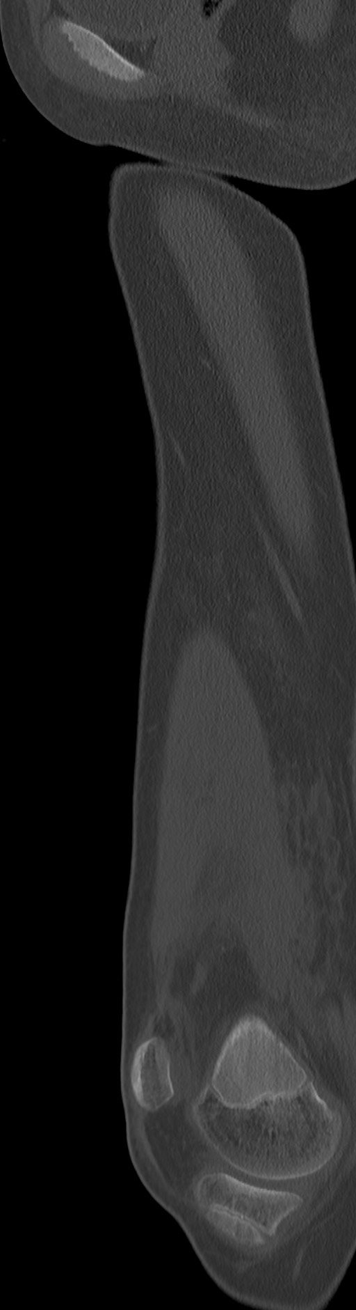 Chronic ostemyelitis of the femur with long sinus tract (Radiopaedia 74947-85982 Sagittal bone window 67).jpg