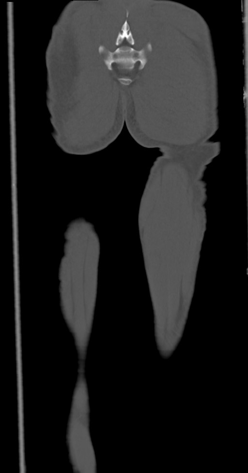 Chronic osteomyelitis (with sequestrum) (Radiopaedia 74813-85822 Coronal non-contrast 53).jpg