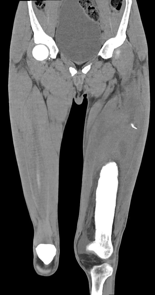 Chronic osteomyelitis (with sequestrum) (Radiopaedia 74813-85822 E 19).jpg