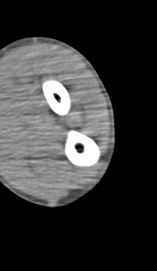 Chronic osteomyelitis of the distal humerus (Radiopaedia 78351-90971 Axial non-contrast 121).jpg
