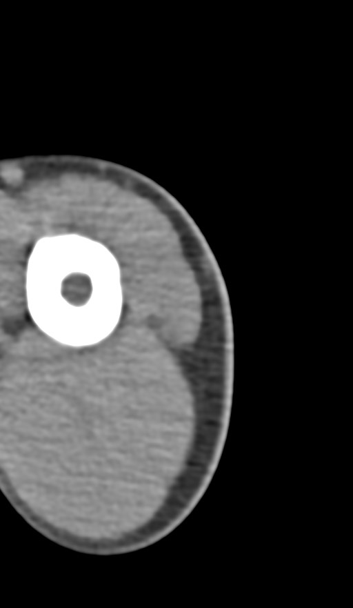 Chronic osteomyelitis of the distal humerus (Radiopaedia 78351-90971 Axial non-contrast 8).jpg