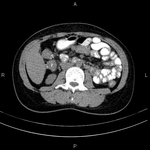 Chronic pancreatitis (Radiopaedia 64576-73450 Axial non-contrast 79).jpg