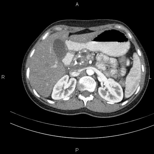 File:Chronic pancreatitis (Radiopaedia 64576-73450 B 45).jpg