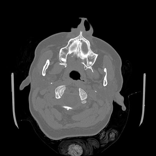 Chronic sinusitis with intra-sinus calcification (Radiopaedia 63919-72668 Axial bone window 80).jpg