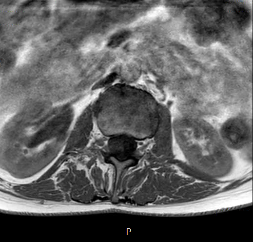 File:Chronic spinal hematoma with cauda equina syndrome (Radiopaedia 75745-87090 Axial T1 6).png