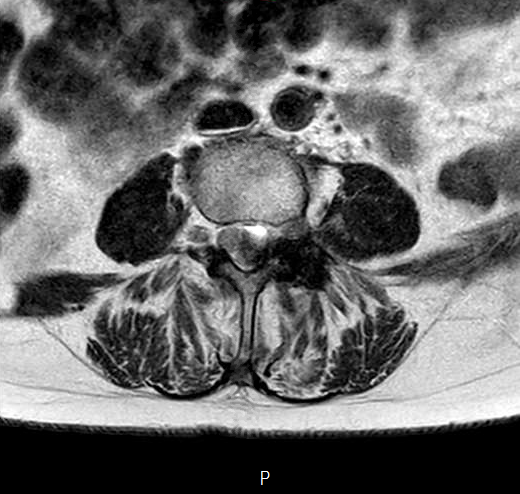 File:Chronic spinal hematoma with cauda equina syndrome (Radiopaedia 75745-87090 Axial T2 10).png