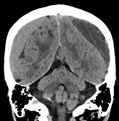 Chronic subdural hematomas (Radiopaedia 66577-75885 Coronal non-contrast 43).jpg
