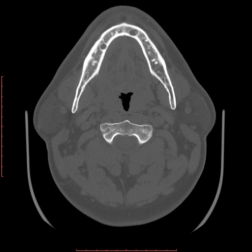 Chronic submandibular sialolithiasis (Radiopaedia 69817-79814 Axial bone window 56).jpg
