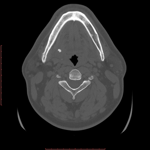Chronic submandibular sialolithiasis (Radiopaedia 69817-79814 Axial bone window 71).jpg