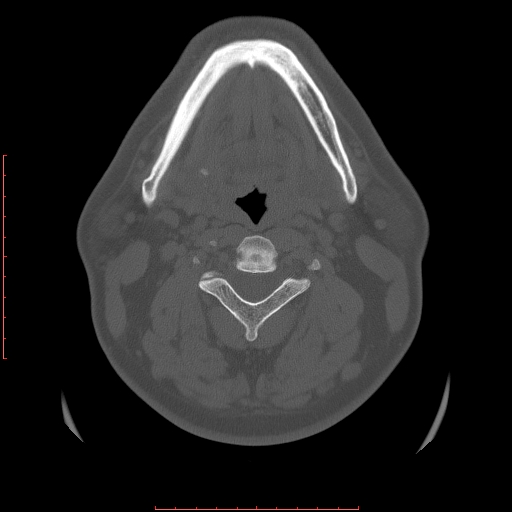 Chronic submandibular sialolithiasis (Radiopaedia 69817-79814 Axial bone window 75).jpg