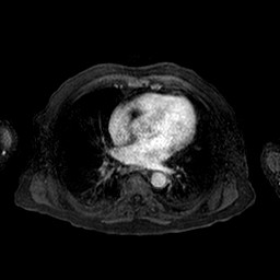 Cirrhosis and hepatocellular carcinoma in the setting of hemochromatosis (Radiopaedia 75394-86594 Axial T1 C+ fat sat 174).jpg