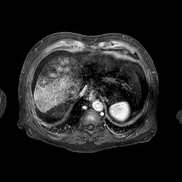 Cirrhosis and hepatocellular carcinoma in the setting of hemochromatosis (Radiopaedia 75394-86594 Axial T1 C+ fat sat 237).jpg