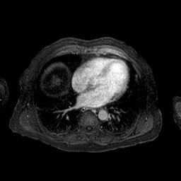 Cirrhosis and hepatocellular carcinoma in the setting of hemochromatosis (Radiopaedia 75394-86594 Axial T1 C+ fat sat 255).jpg