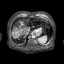 Cirrhosis and hepatocellular carcinoma in the setting of hemochromatosis (Radiopaedia 75394-86594 Axial T1 C+ fat sat 320).jpg