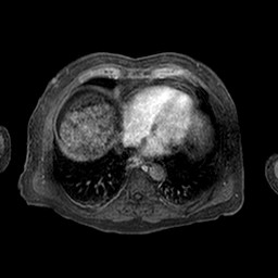 Cirrhosis and hepatocellular carcinoma in the setting of hemochromatosis (Radiopaedia 75394-86594 Axial T1 C+ fat sat 335).jpg