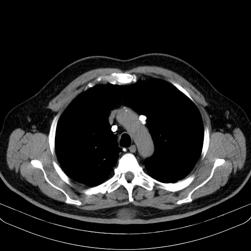 Classic complicated silicosis (Radiopaedia 49720-54961 Axial liver window 16).jpg