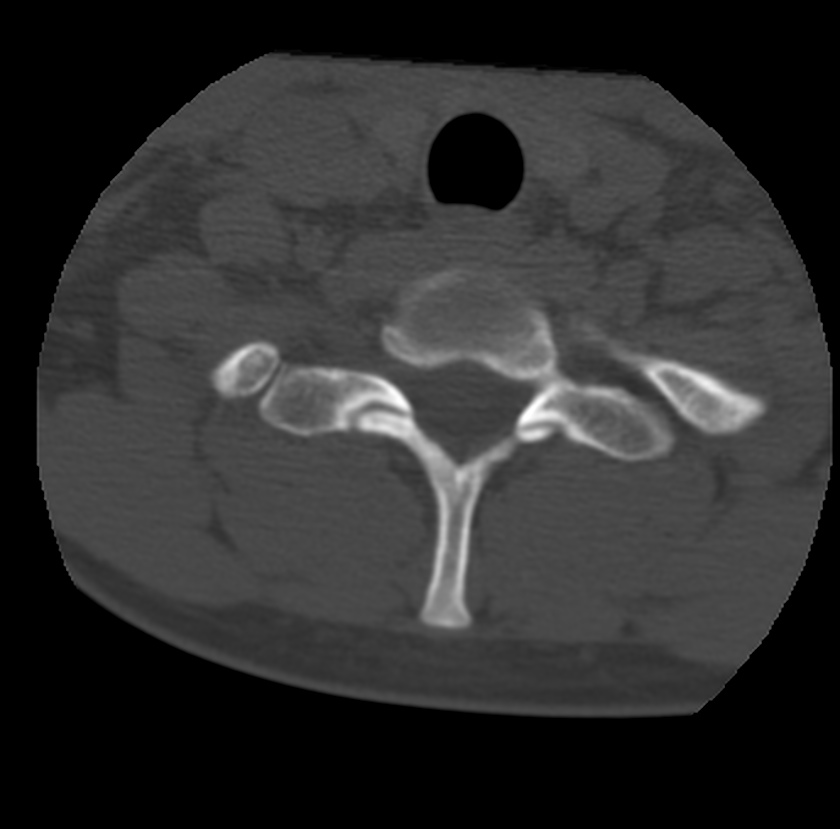 Clay-shoveler fracture (Radiopaedia 22568-22590 Axial bone window 65).jpg