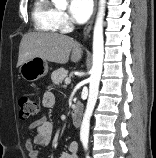 File:Clear cell renal cell carcinoma (Radiopaedia 61449-69393 D 54).jpg