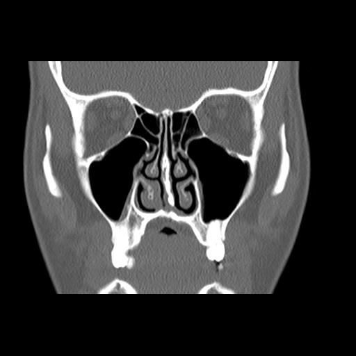 File:Cleft hard palate and alveolus (Radiopaedia 63180-71710 Coronal bone window 20).jpg