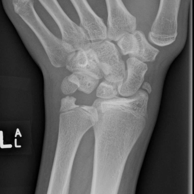 File:Cleft ulnar epiphysis and persistent radial styloid (Radiopaedia 24382-24672 Coned frontal 1).jpg