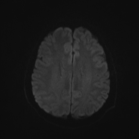 File:Clival meningioma (Radiopaedia 53278-59248 Axial DWI 42).jpg