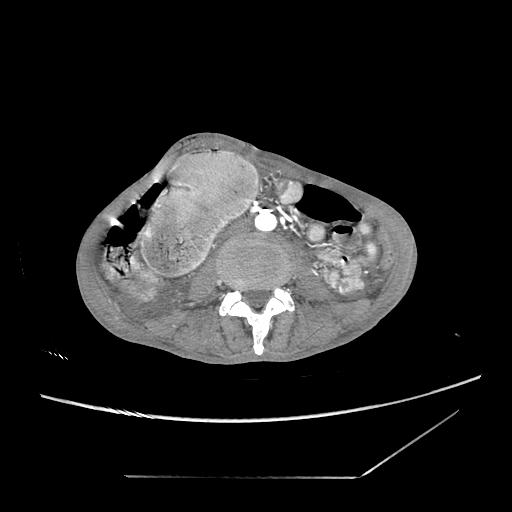 Closed-loop obstruction due to peritoneal seeding mimicking internal hernia after total gastrectomy (Radiopaedia 81897-95864 A 109).jpg