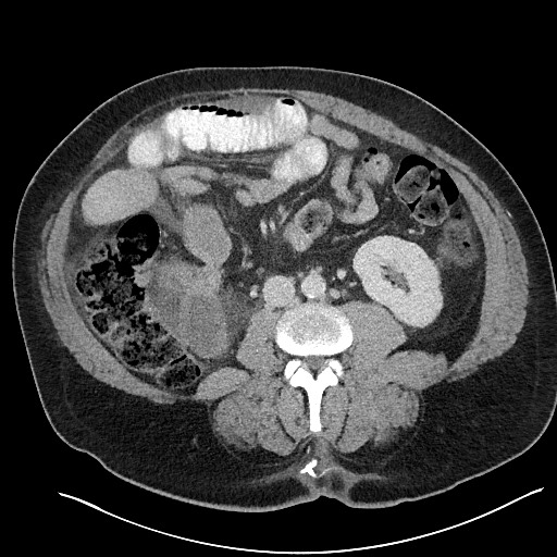 File:Closed loop obstruction - internal hernia into nephrectomy bed (Radiopaedia 59867-67320 A 77).jpg