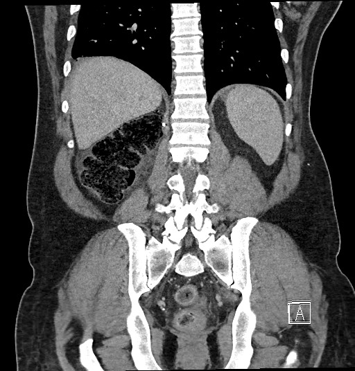 File:Closed loop obstruction - internal hernia into nephrectomy bed (Radiopaedia 59867-67320 B 104).jpg