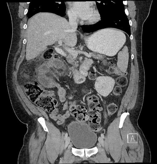 Closed loop obstruction - internal hernia into nephrectomy bed (Radiopaedia 59867-67320 B 63).jpg