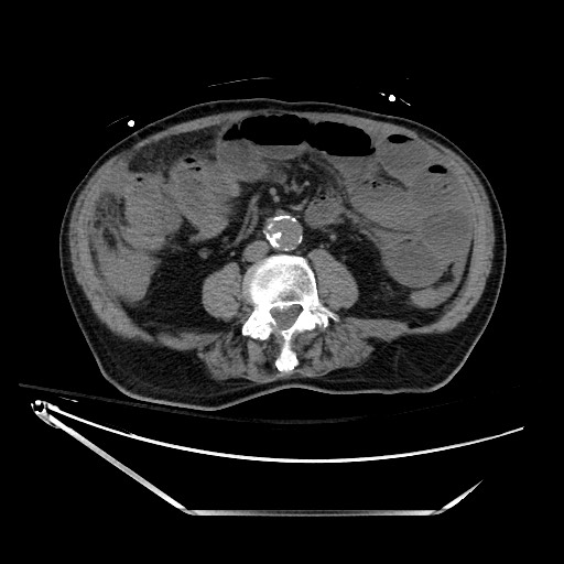 File:Closed loop obstruction due to adhesive band, resulting in small bowel ischemia and resection (Radiopaedia 83835-99023 Axial 33).jpg