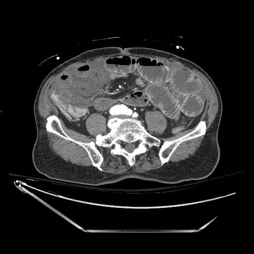 File:Closed loop obstruction due to adhesive band, resulting in small bowel ischemia and resection (Radiopaedia 83835-99023 B 100).jpg