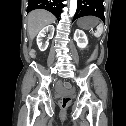 Closed loop obstruction due to adhesive band, resulting in small bowel ischemia and resection (Radiopaedia 83835-99023 C 84).jpg