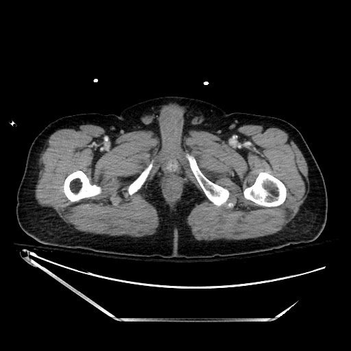 File:Closed loop obstruction due to adhesive band, resulting in small bowel ischemia and resection (Radiopaedia 83835-99023 D 171).jpg