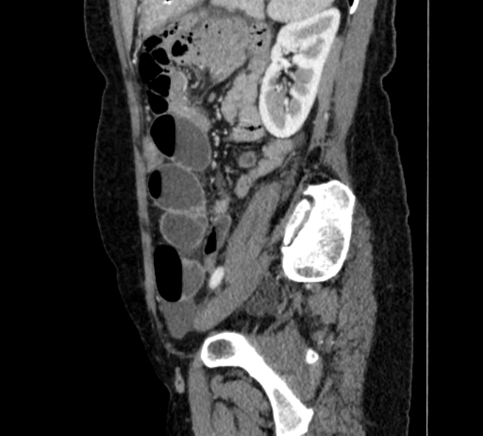 Closed loop small bowel obstruction (Radiopaedia 71211-81508 C 118).jpg